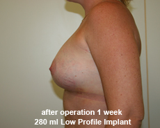 plastic-surgery-breast-augmentation